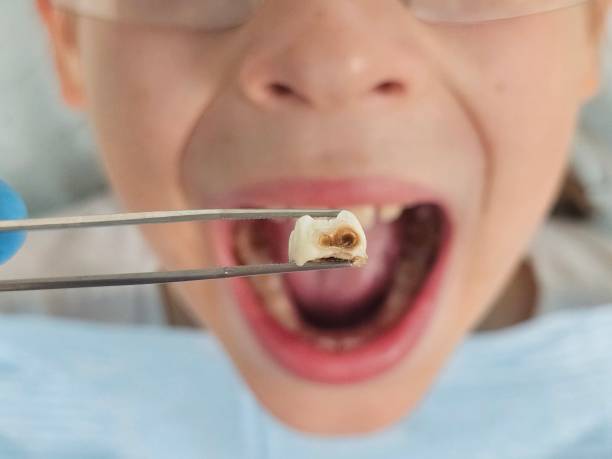 Best Dentist for Tooth Abscess  in Moody, AL